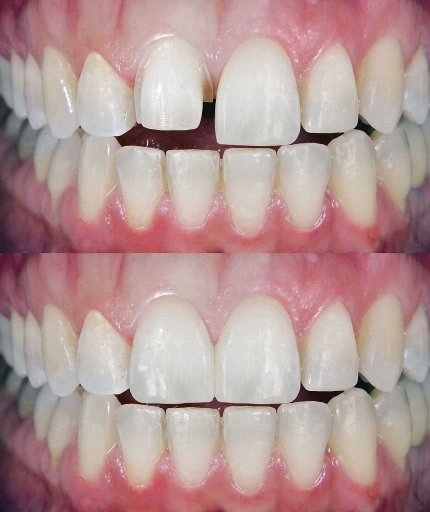 dental-veneers