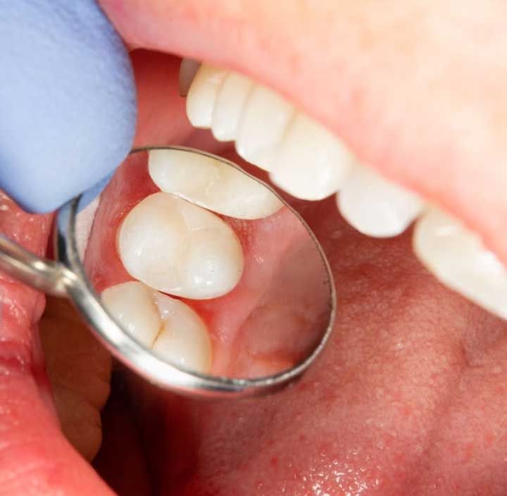 preventative-dentistry