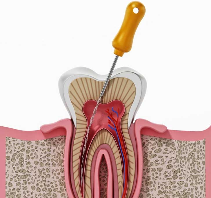 root-canal-treatment