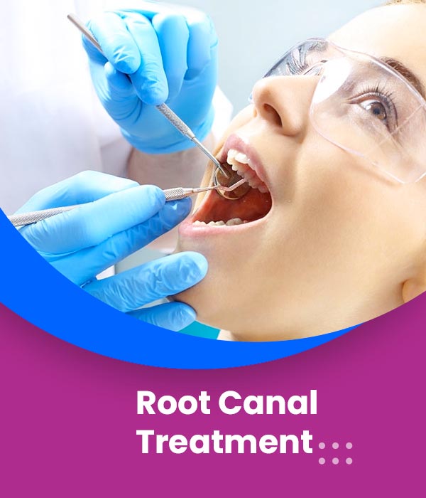 root-canal-treatment