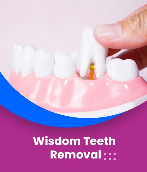 wisdom-teeth-removal