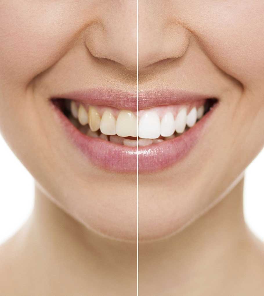 teeth-whitening