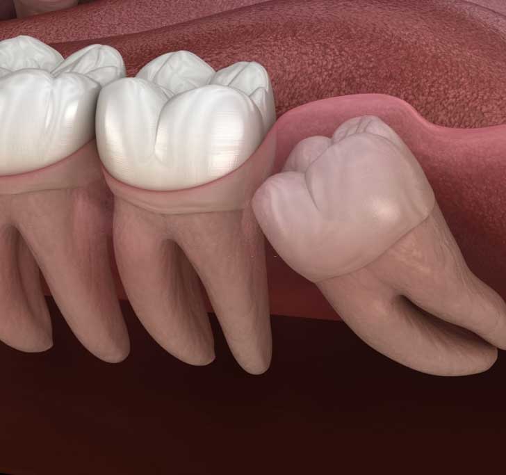 Wisdom Teeth Removal Bicton Dental